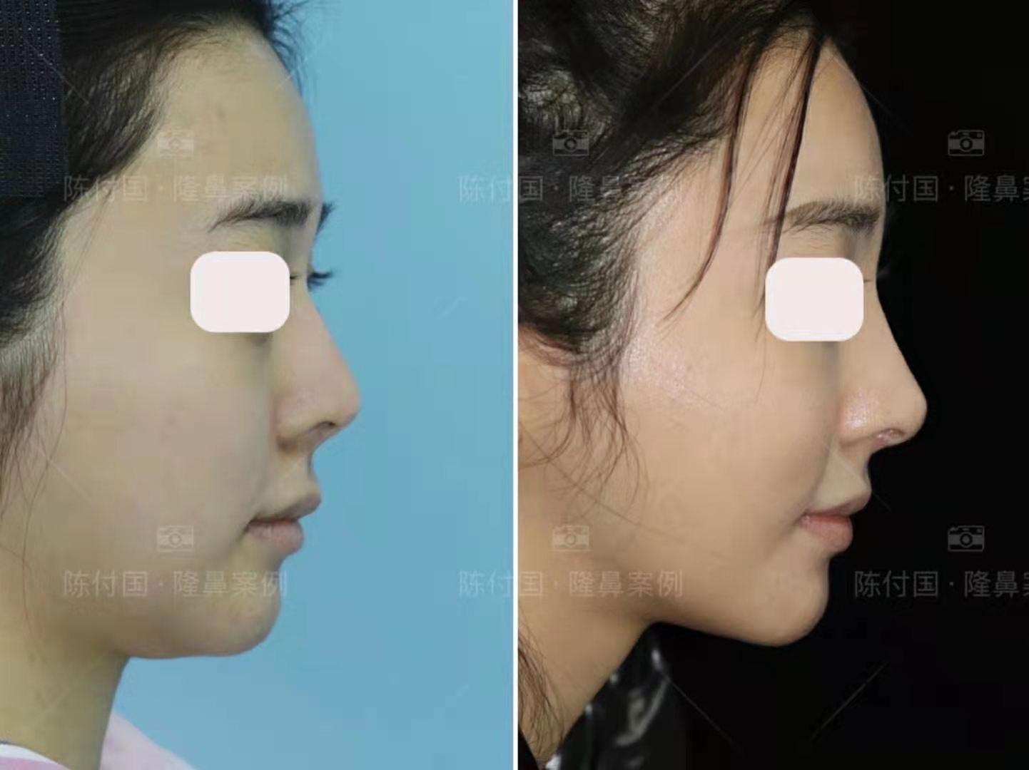 揭秘，一岁娃娃鼻孔长出豆芽背后的真相