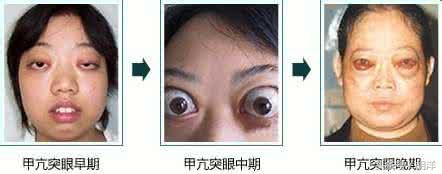 揭秘中国甲亢病发状况，哪个省份病人多？