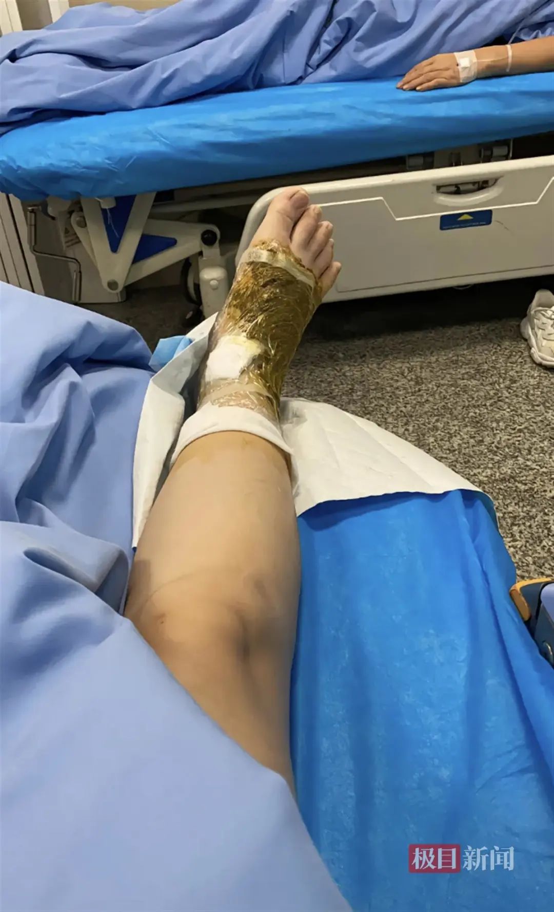 三亚被咬女子确认为神经毒蛇咬伤事件分析