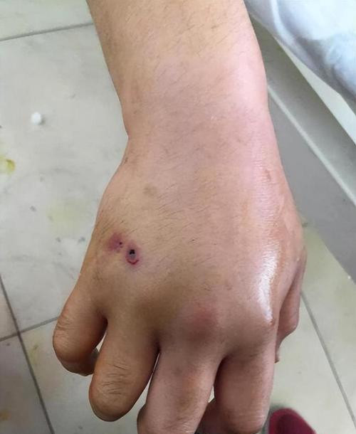 被蛇咬了十几年后疼，经历与反思