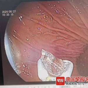 误吞勺子半年后发现胃疼
