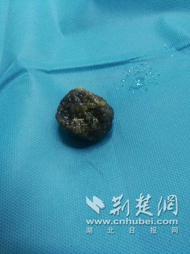 大爷体内惊现1791颗结石，一场与病魔的较量
