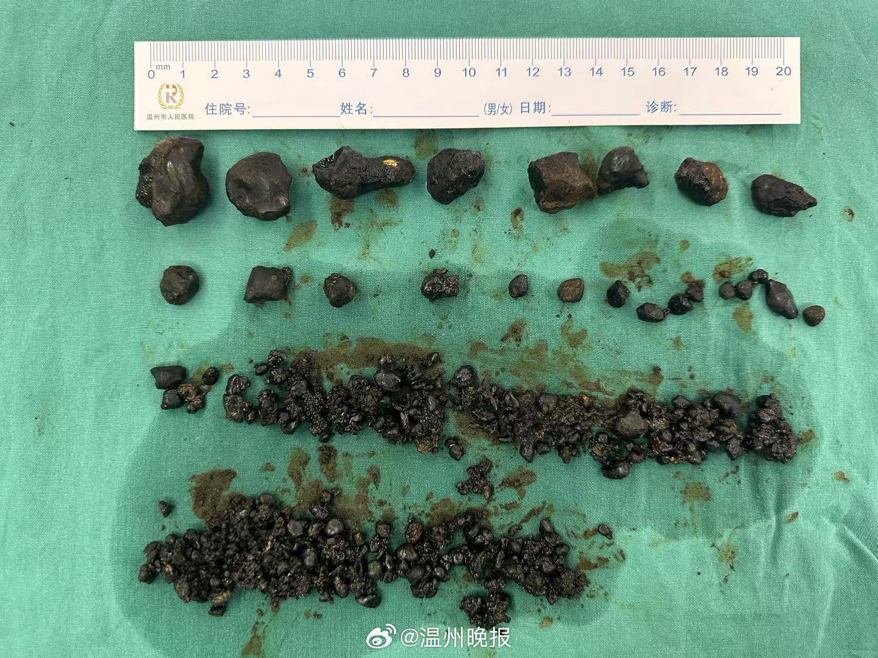 大爷体内惊现1791颗结石，一场与病魔的较量