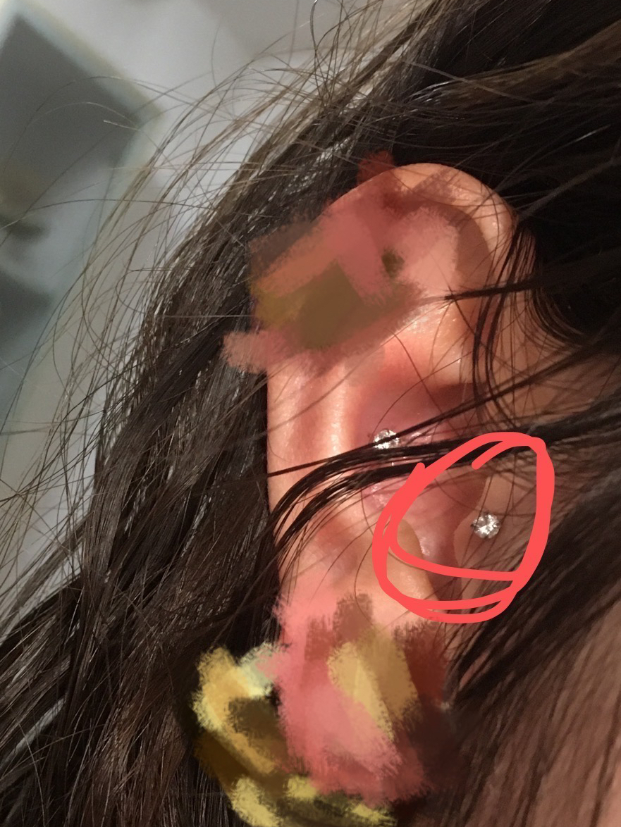 带耳钉后面的耳堵不见了，晚上睡觉耳钉会掉下来吗？一篇文章解析