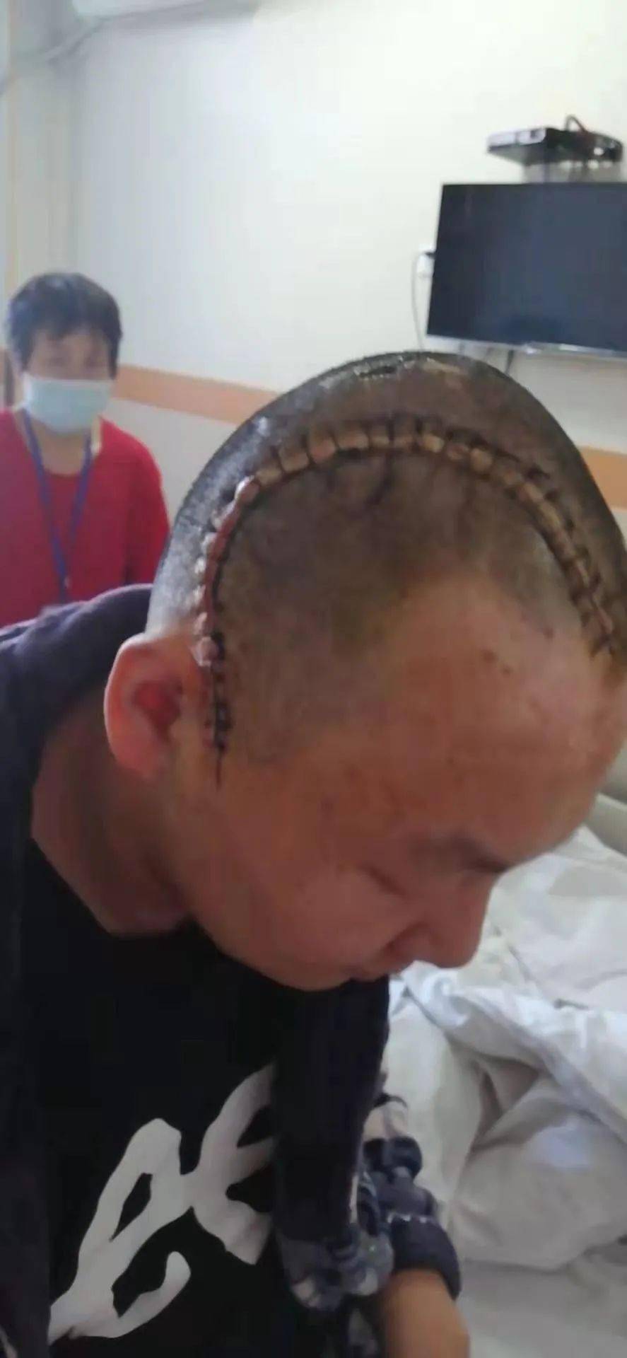 患罕见病男孩成功摘除头部扩张器，重燃生命之光