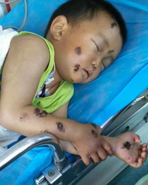 幼童遭遇蜜蜂蛰咬事件解析