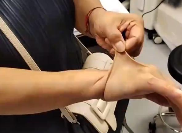 橡皮女子，罕见病症挑战皮肤极限