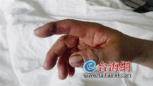 被蛇咬饮药酒险断臂，一场命运的博弈