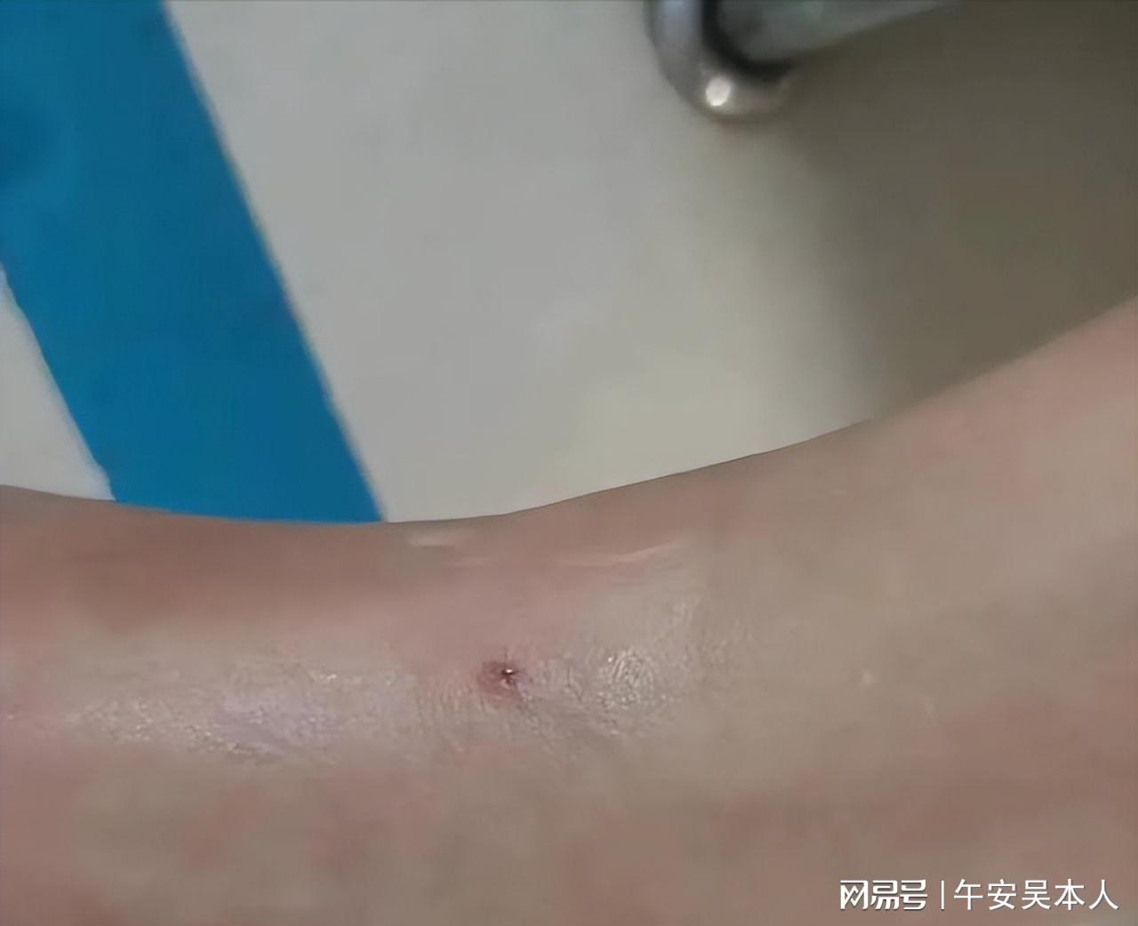 女子旅游遭遇蛇咬事件，应对与反思