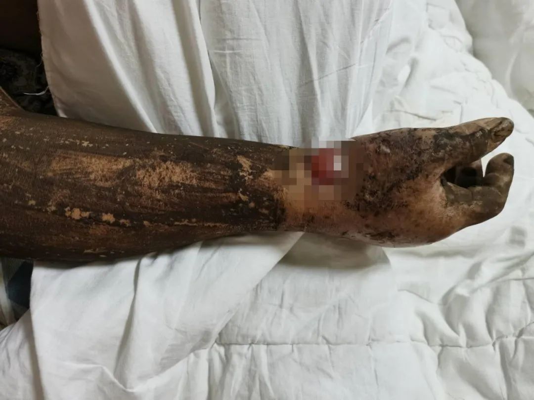 被蛇咬几十年后可能出现的后遗症及其影响