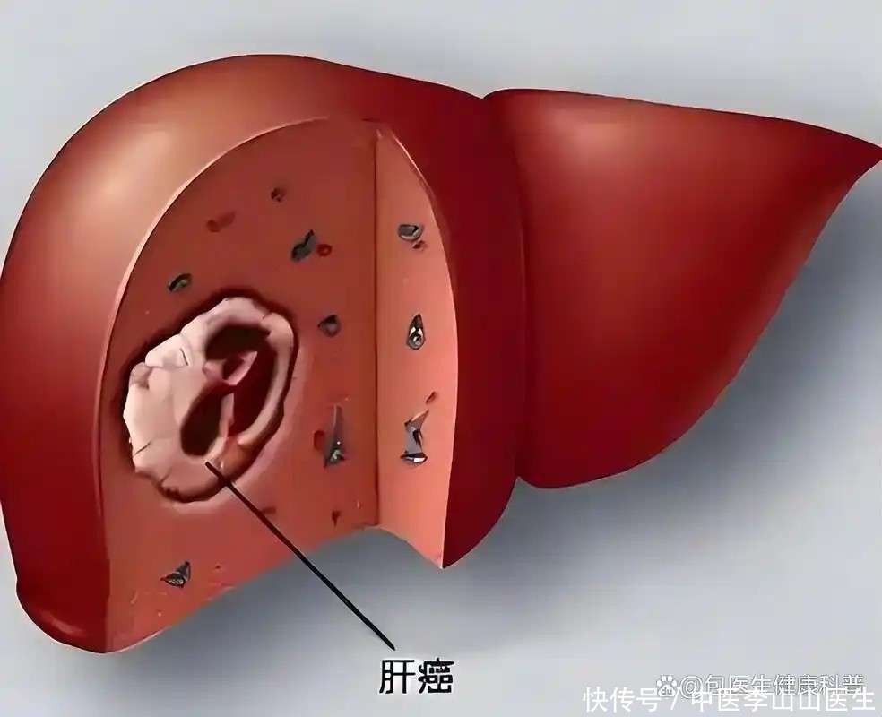 怀孕期间查出肝癌晚期怎么办