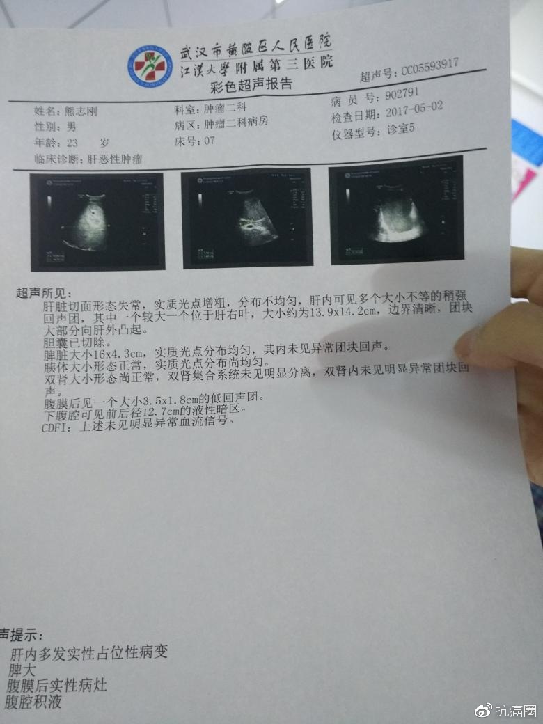 怀孕期间查出肝癌晚期怎么办
